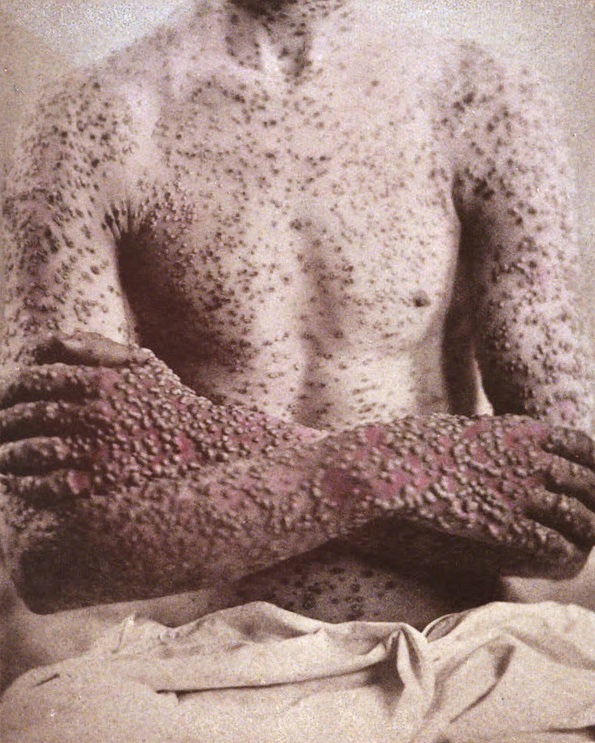 smallpox-1886.jpg